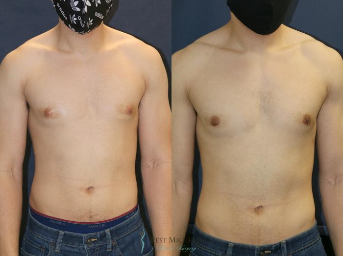 Before & After Gynecomastia Case 9353 Front View in Kalamazoo & Grand Rapids, Michigan