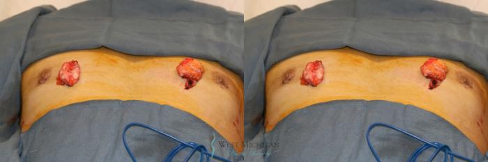 Before & After Gynecomastia Case 9353 intraoperative View in Kalamazoo & Grand Rapids, Michigan