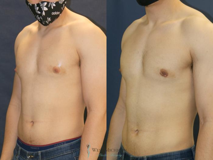 Before & After Gynecomastia Case 9353 Left Oblique View in Kalamazoo & Grand Rapids, Michigan