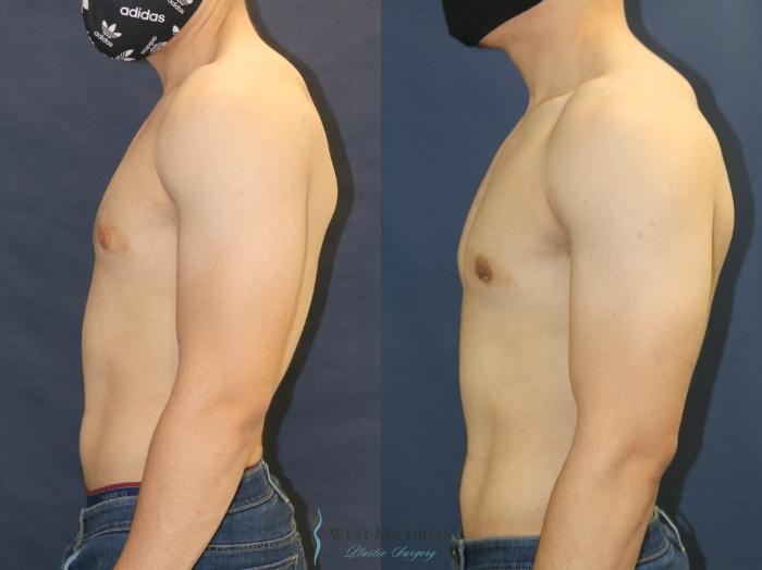 Before & After Gynecomastia Case 9353 Left Side View in Kalamazoo & Grand Rapids, Michigan