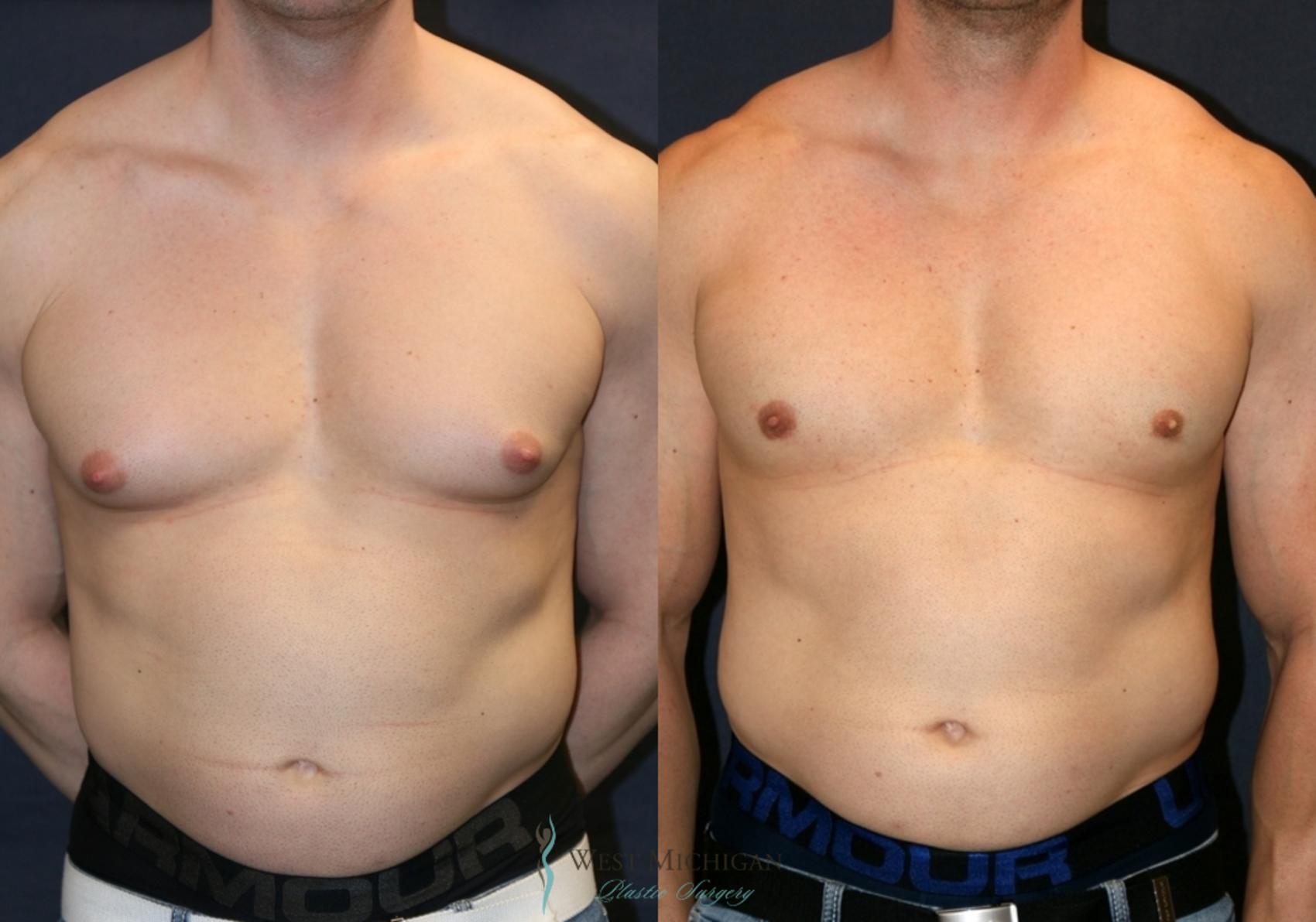 Before & After Gynecomastia Case 9360 Front View in Portage, Kalamazoo, Battle Creek, Michigan