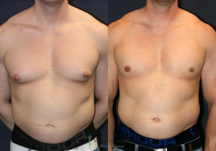 Before & After Gynecomastia Case 9360 Front View in Kalamazoo & Grand Rapids, Michigan