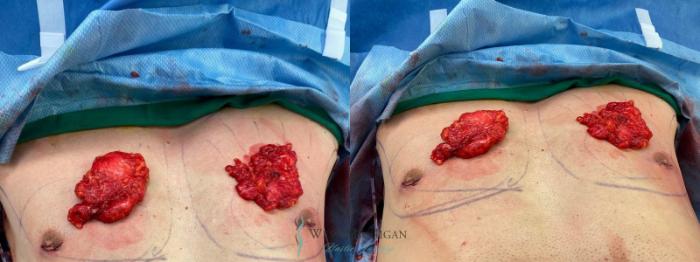 Before & After Gynecomastia Case 9360 Intraoperative View in Kalamazoo & Grand Rapids, Michigan