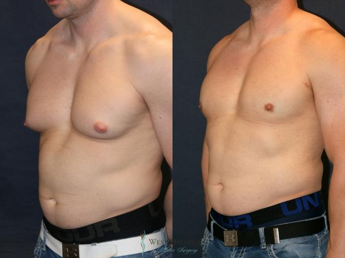 Before & After Gynecomastia Case 9360 Left Oblique View in Kalamazoo & Grand Rapids, Michigan