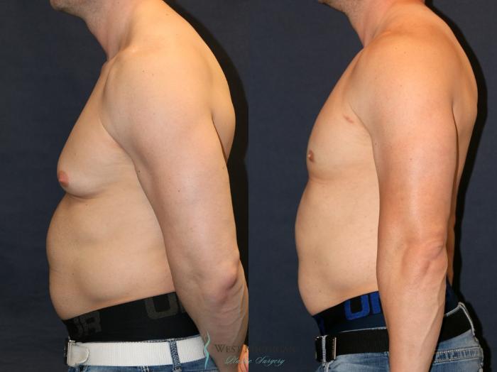 Before & After Gynecomastia Case 9360 Left Side View in Portage, Kalamazoo, Battle Creek, Michigan