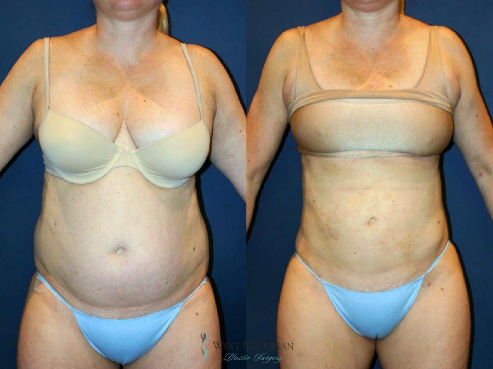 Before & After Liposuction Case 8703 View #1 View in Portage, Kalamazoo, Battle Creek, Michigan