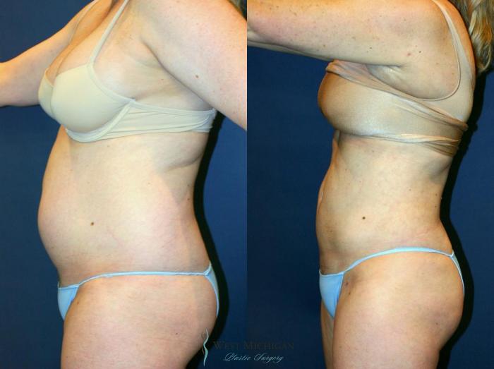 Before & After Liposuction Case 8703 View #2 View in Portage, Kalamazoo, Battle Creek, Michigan