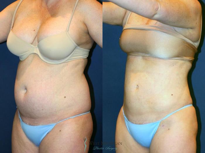 Before & After Liposuction Case 8703 View #3 View in Portage, Kalamazoo, Battle Creek, Michigan
