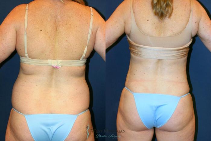 Before & After Liposuction Case 8703 View #4 View in Portage, Kalamazoo, Battle Creek, Michigan