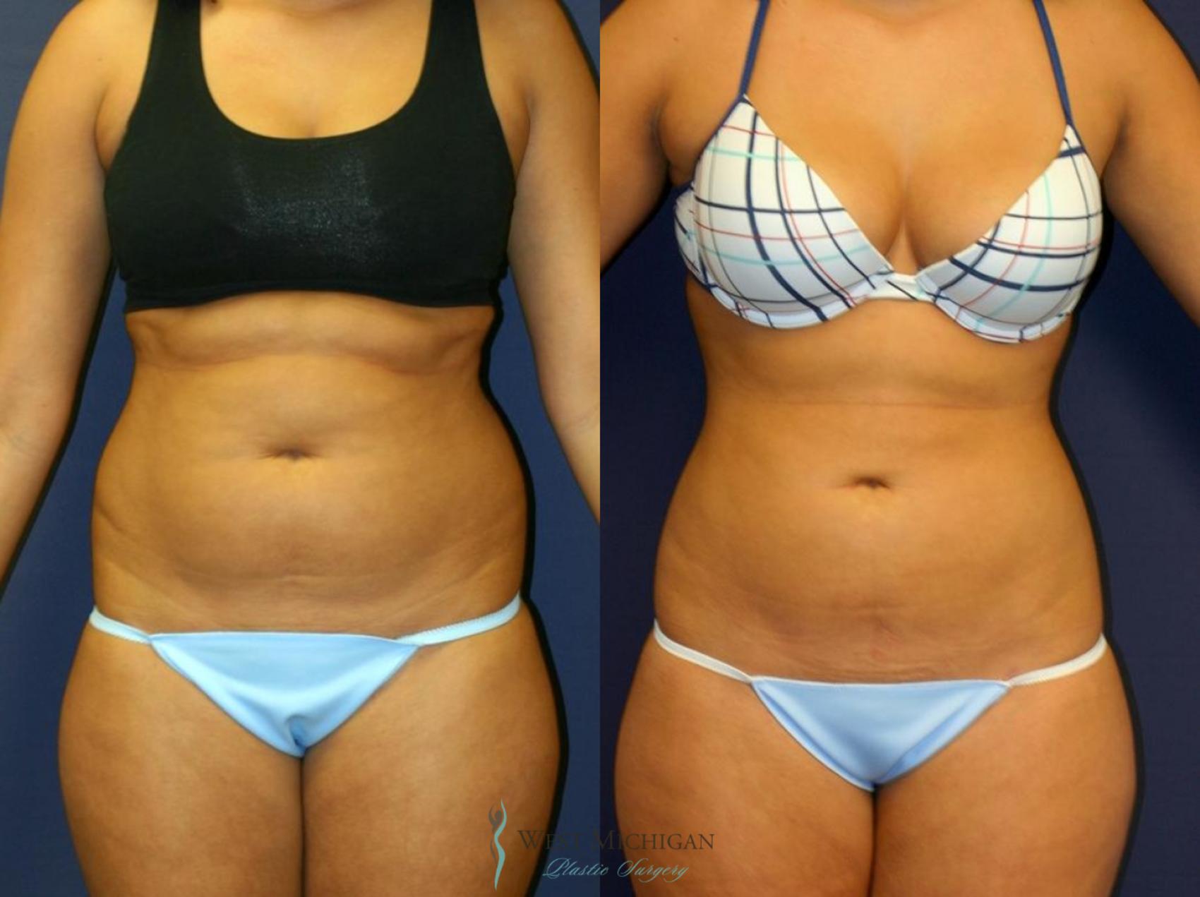 Before & After Liposuction Case 8704 View #1 View in Portage, Kalamazoo, Battle Creek, Michigan