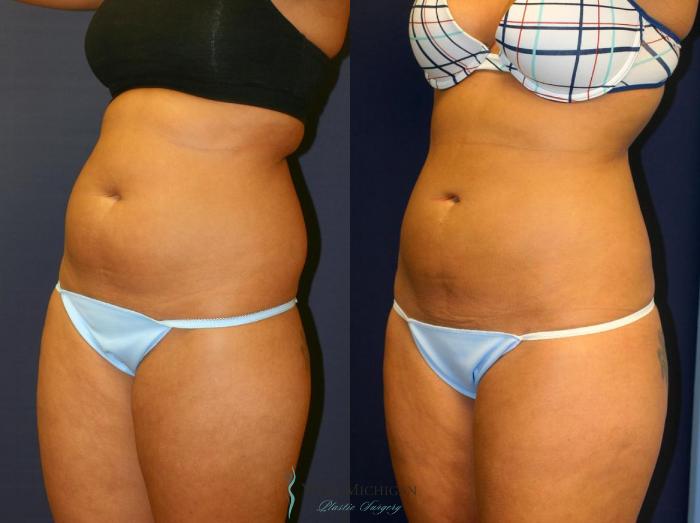 Before & After Liposuction Case 8704 View #2 View in Portage, Kalamazoo, Battle Creek, Michigan