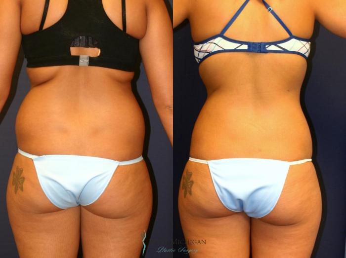 Before & After Liposuction Case 8704 View #3 View in Portage, Kalamazoo, Battle Creek, Michigan