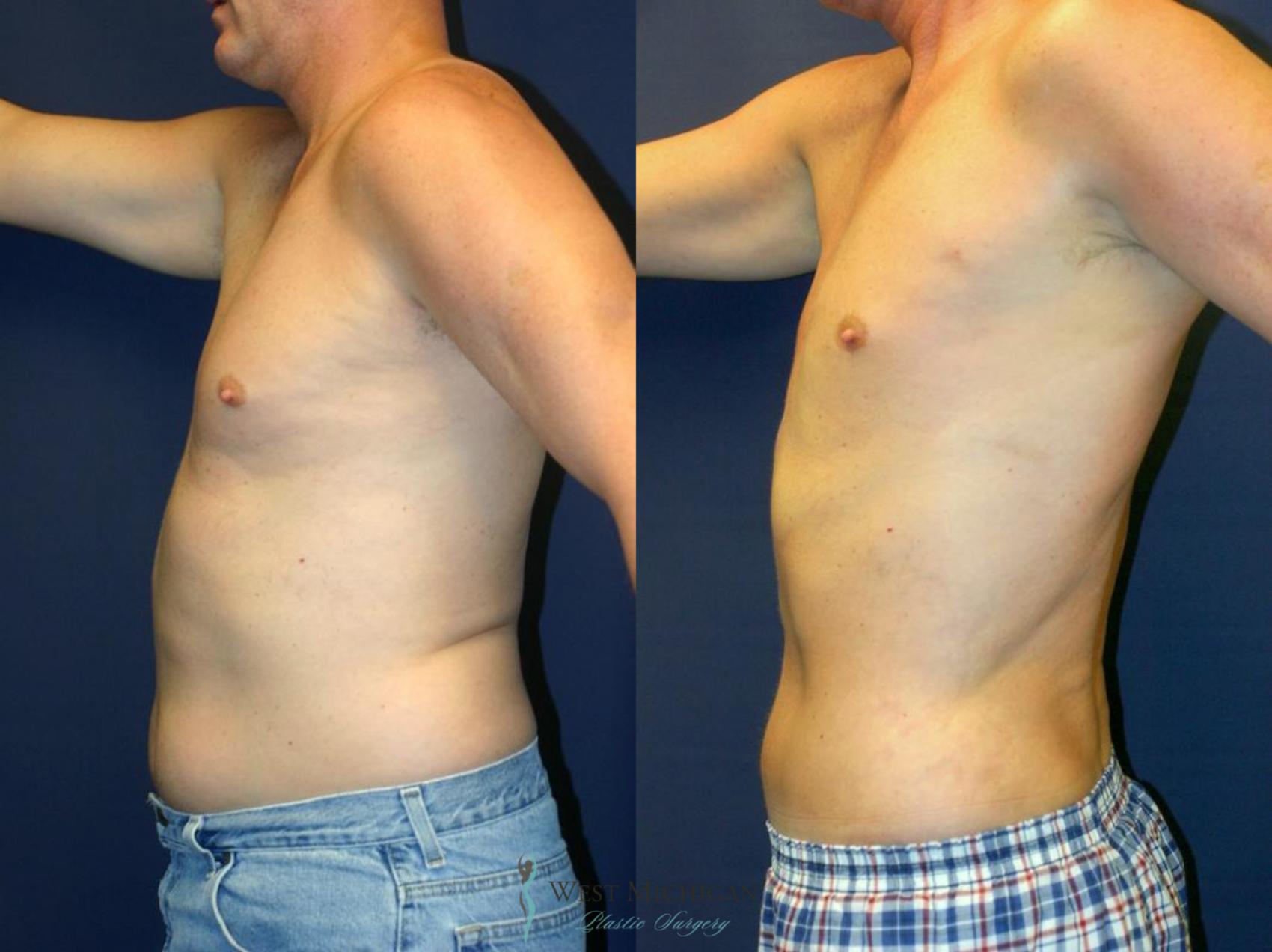 Before & After Liposuction Case 8935 View #1 View in Portage, Kalamazoo, Battle Creek, Michigan