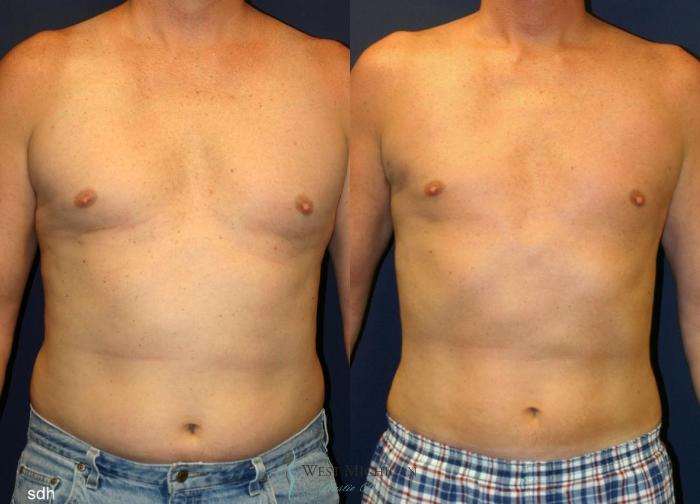 Before & After Liposuction Case 8935 View #2 View in Portage, Kalamazoo, Battle Creek, Michigan