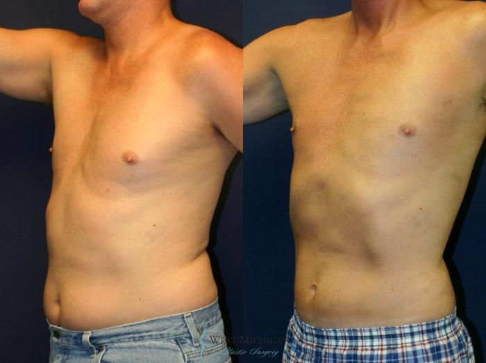 Before & After Liposuction Case 8935 View #3 View in Portage, Kalamazoo, Battle Creek, Michigan