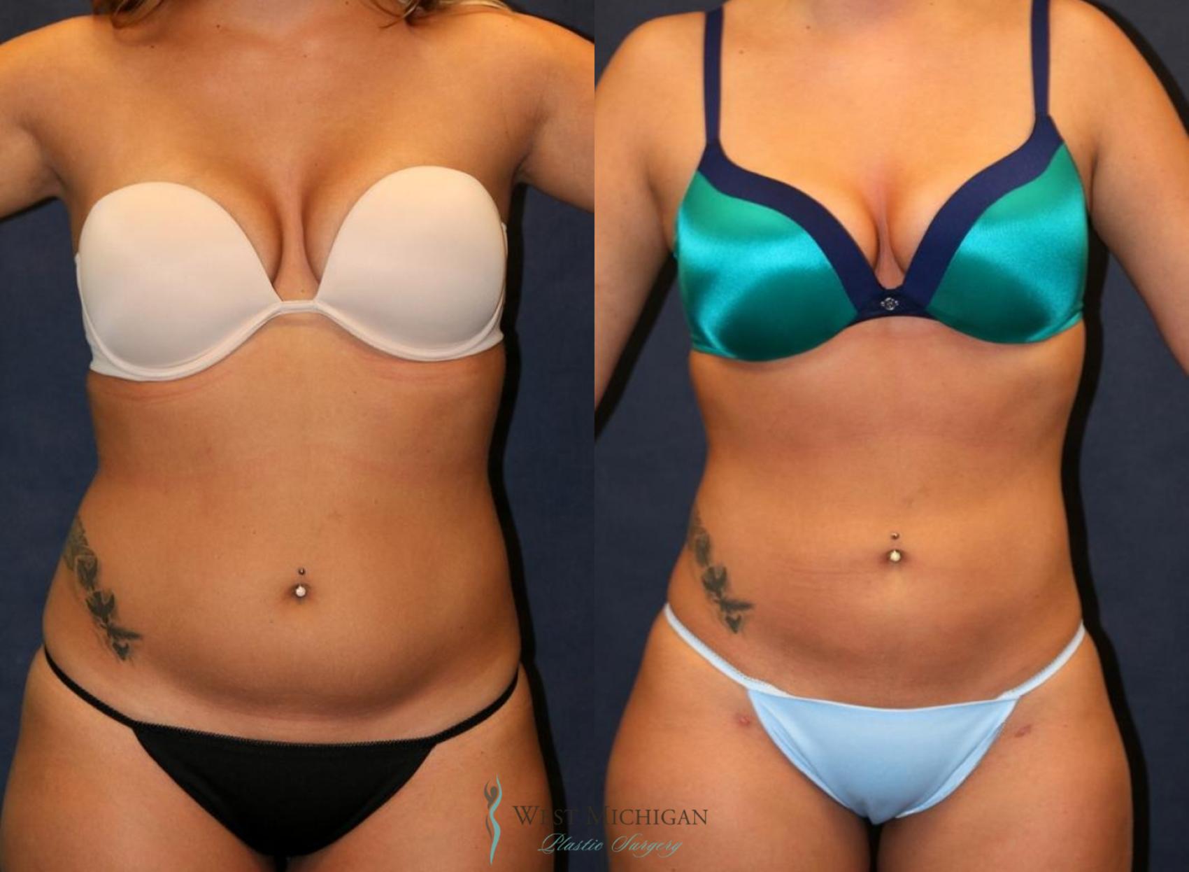 Before & After Liposuction Case 8949 View #1 View in Portage, Kalamazoo, Battle Creek, Michigan