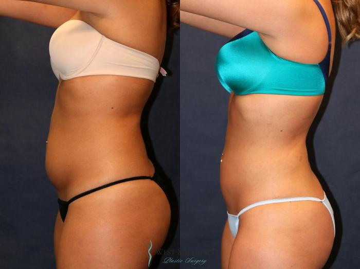 Before & After Liposuction Case 8949 View #2 View in Portage, Kalamazoo, Battle Creek, Michigan