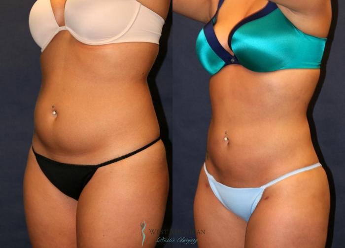Before & After Liposuction Case 8949 View #3 View in Portage, Kalamazoo, Battle Creek, Michigan