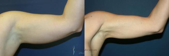 Before & After Liposuction Case 8950 View #1 View in Portage, Kalamazoo, Battle Creek, Michigan