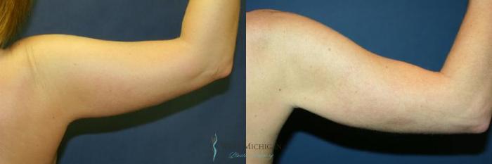 Before & After Liposuction Case 8950 View #3 View in Portage, Kalamazoo, Battle Creek, Michigan