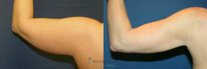 Before & After Liposuction Case 8950 View #4 View in Portage, Kalamazoo, Battle Creek, Michigan