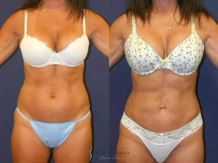 Before & After Liposuction Case 8951 View #1 View in Portage, Kalamazoo, Battle Creek, Michigan