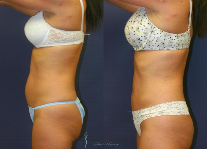 Before & After Liposuction Case 8951 View #2 View in Portage, Kalamazoo, Battle Creek, Michigan