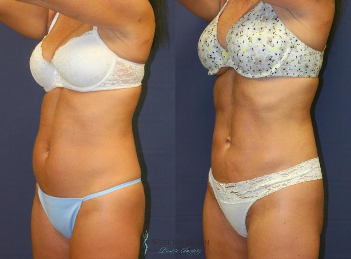 Before & After Liposuction Case 8951 View #3 View in Portage, Kalamazoo, Battle Creek, Michigan