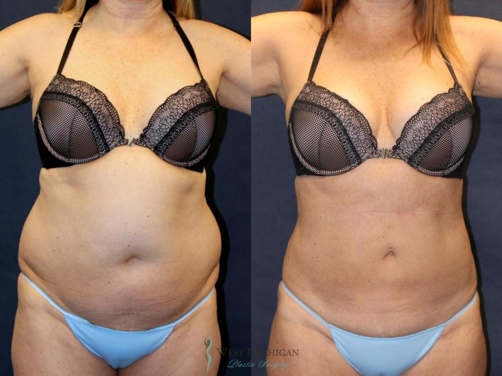 Before & After Liposuction Case 8952 View #1 View in Portage, Kalamazoo, Battle Creek, Michigan