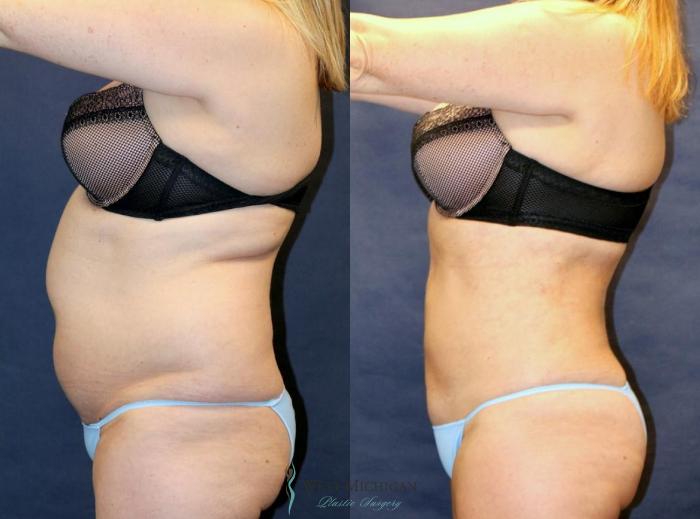 Before & After Liposuction Case 8952 View #2 View in Portage, Kalamazoo, Battle Creek, Michigan