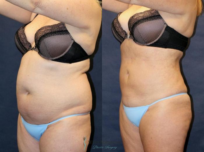 Before & After Liposuction Case 8952 View #3 View in Portage, Kalamazoo, Battle Creek, Michigan