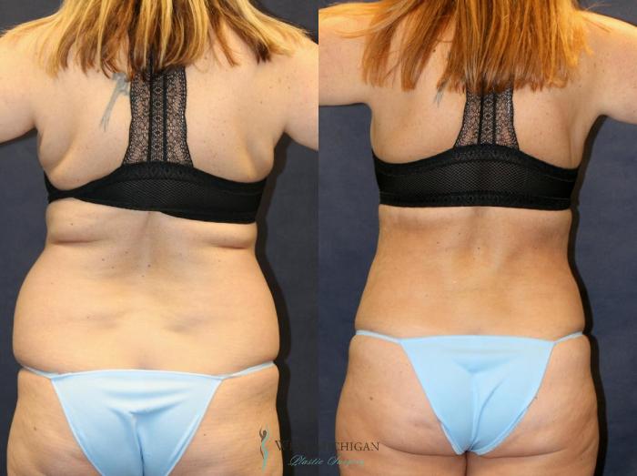 Before & After Liposuction Case 8952 View #4 View in Portage, Kalamazoo, Battle Creek, Michigan