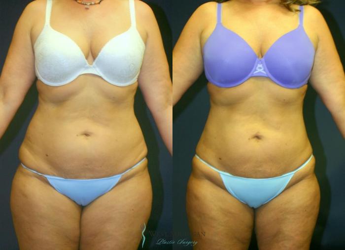 Before & After Liposuction Case 8954 View #1 View in Portage, Kalamazoo, Battle Creek, Michigan