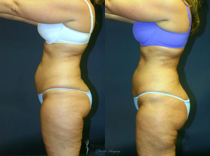 Before & After Liposuction Case 8954 View #2 View in Portage, Kalamazoo, Battle Creek, Michigan