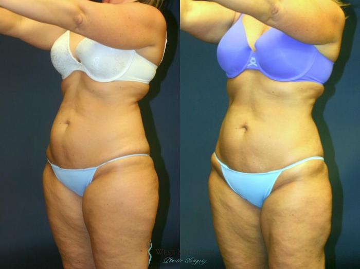 Before & After Liposuction Case 8954 View #3 View in Portage, Kalamazoo, Battle Creek, Michigan