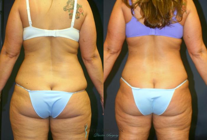 Before & After Liposuction Case 8954 View #4 View in Portage, Kalamazoo, Battle Creek, Michigan