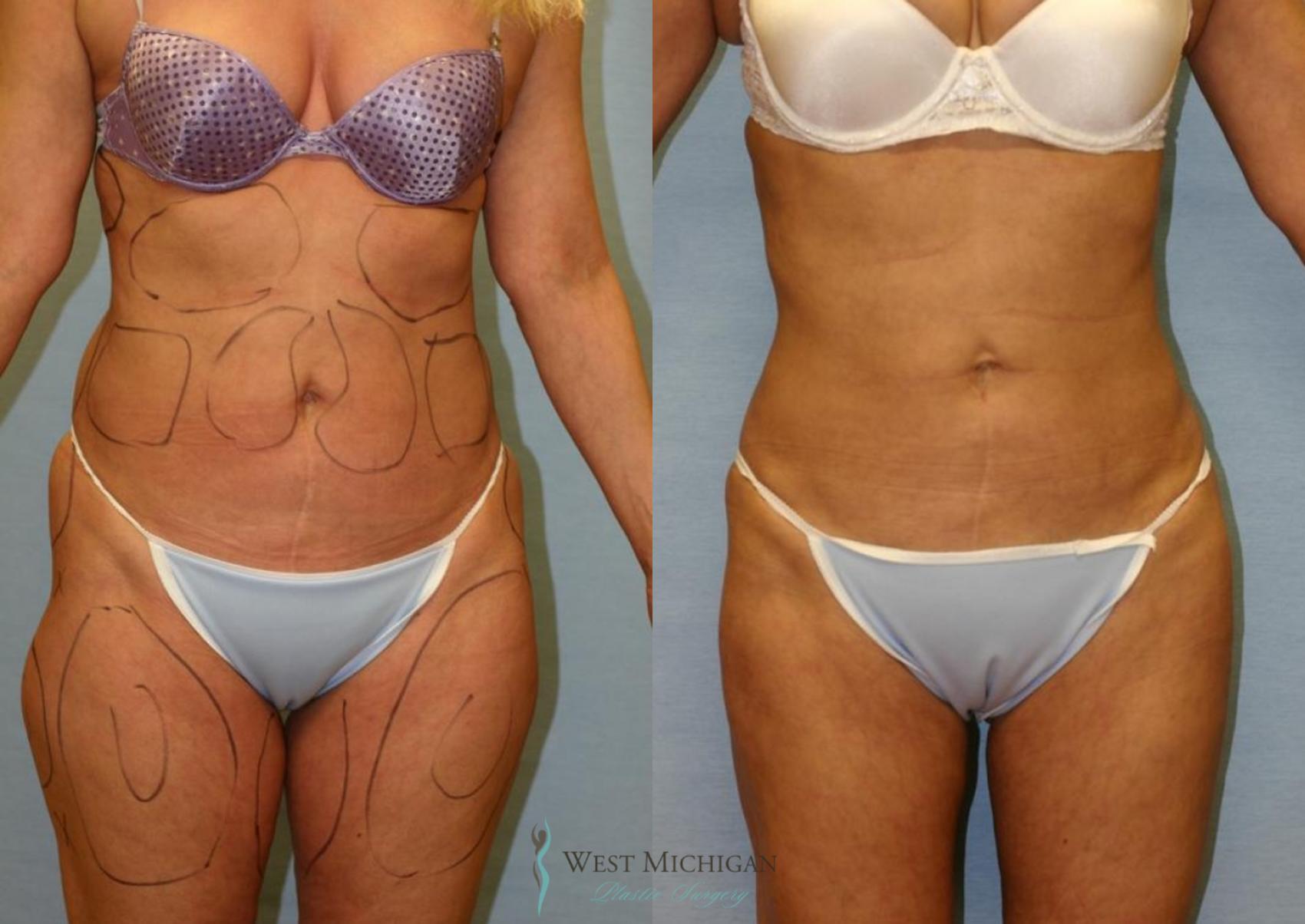 Before & After Liposuction Case 8955 View #1 View in Portage, Kalamazoo, Battle Creek, Michigan