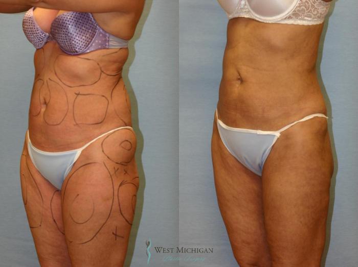 Before & After Liposuction Case 8955 View #2 View in Portage, Kalamazoo, Battle Creek, Michigan