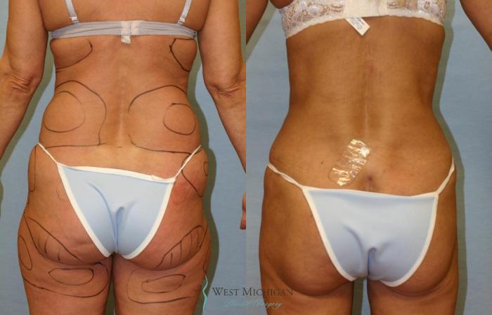 Before & After Liposuction Case 8955 View #3 View in Portage, Kalamazoo, Battle Creek, Michigan