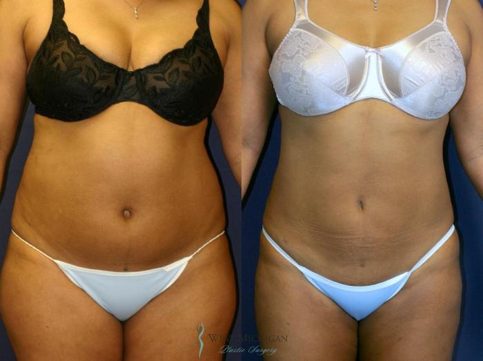 Before & After Liposuction Case 9026 View #1 View in Portage, Kalamazoo, Battle Creek, Michigan