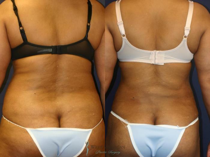 Before & After Liposuction Case 9026 View #2 View in Portage, Kalamazoo, Battle Creek, Michigan
