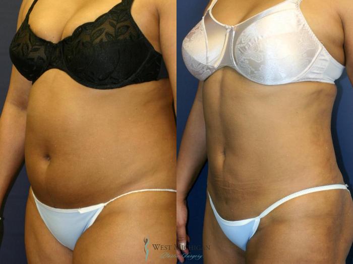 Before & After Liposuction Case 9026 View #3 View in Portage, Kalamazoo, Battle Creek, Michigan