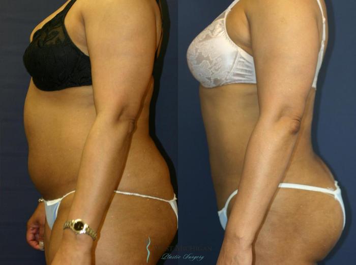 Before & After Liposuction Case 9026 View #4 View in Portage, Kalamazoo, Battle Creek, Michigan