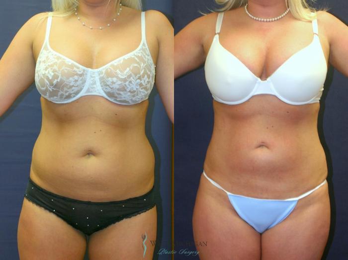 Before & After Liposuction Case 9027 View #1 View in Portage, Kalamazoo, Battle Creek, Michigan