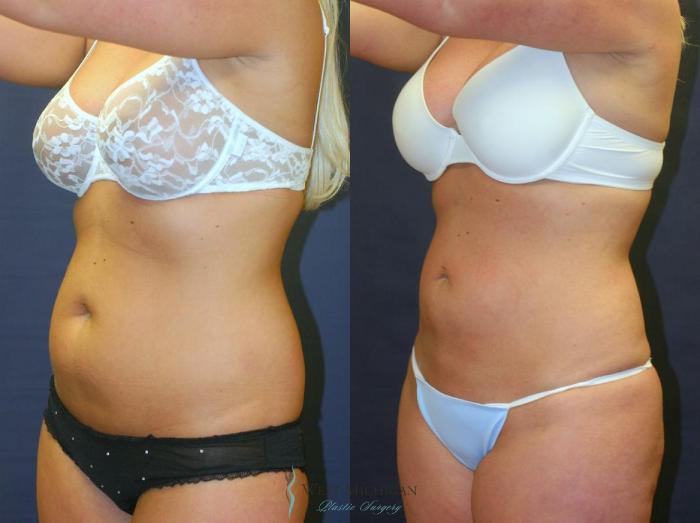 Before & After Liposuction Case 9027 View #2 View in Portage, Kalamazoo, Battle Creek, Michigan