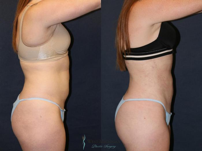 Before & After Liposuction Case 9320 View #2 View in Portage, Kalamazoo, Battle Creek, Michigan
