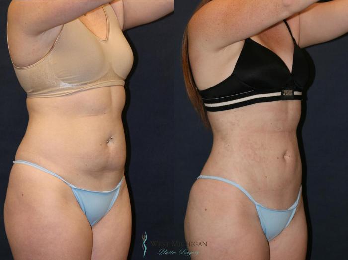 Before & After Liposuction Case 9320 View #3 View in Portage, Kalamazoo, Battle Creek, Michigan
