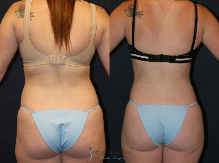 Before & After Liposuction Case 9320 View #4 View in Portage, Kalamazoo, Battle Creek, Michigan