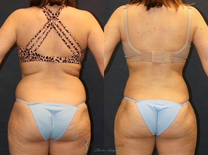 Before & After Liposuction Case 9332 Back View in Portage, Kalamazoo, Battle Creek, Michigan