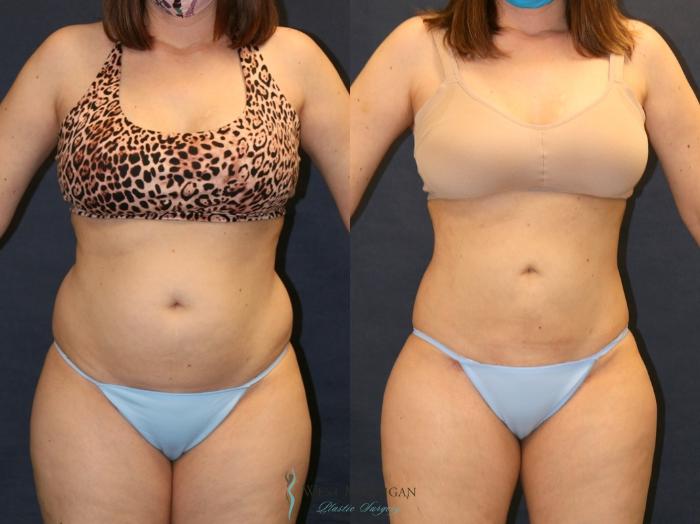 Before & After Liposuction Case 9332 Front View in Portage, Kalamazoo, Battle Creek, Michigan